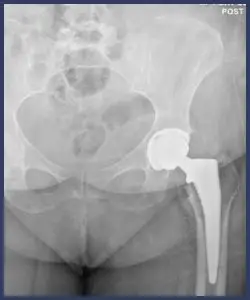 Anterior Total Hip Arthroplasty​ after - Drew Ratner MD Orthopedic Surgeon 1