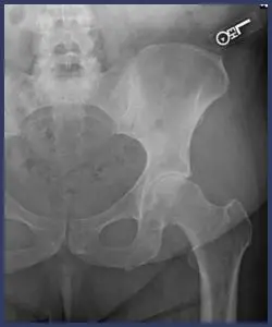 Anterior Total Hip Arthroplasty​ before - Drew Ratner MD Orthopedic Surgeon 1