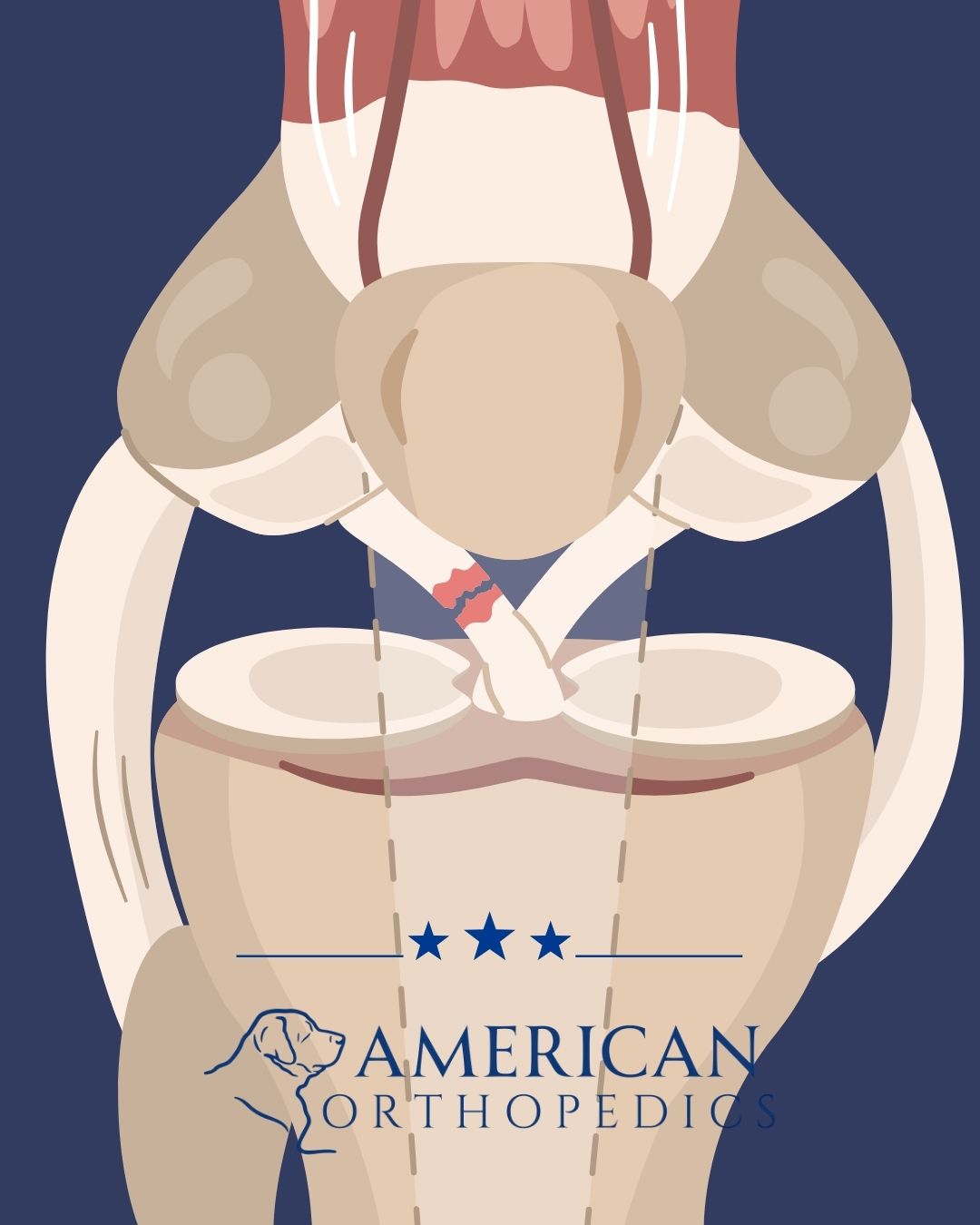 ACL reconstruction illustration dr drew ratner american orthopedics greenville sc (2)