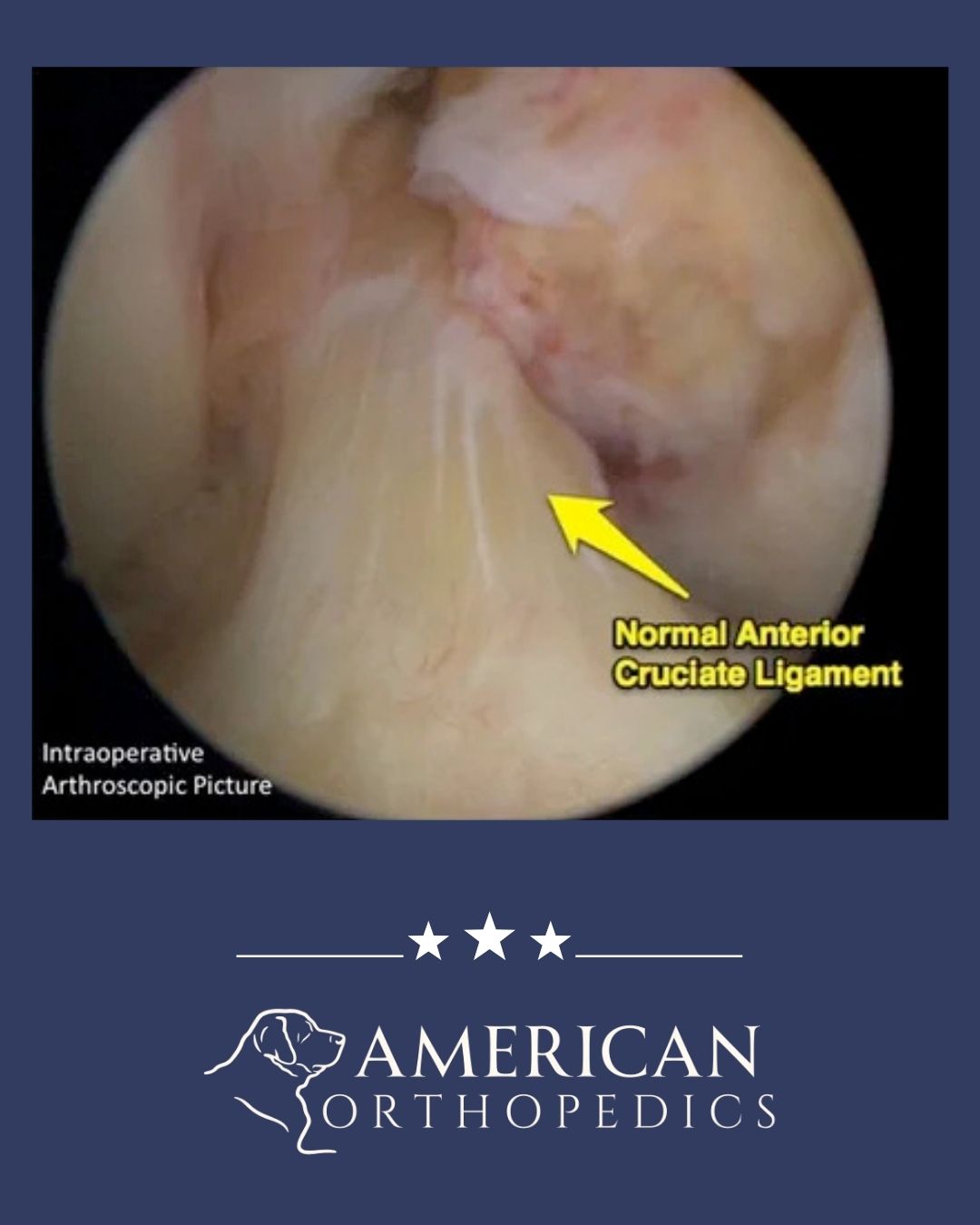 ACL reconstruction illustration dr drew ratner american orthopedics greenville sc (4)