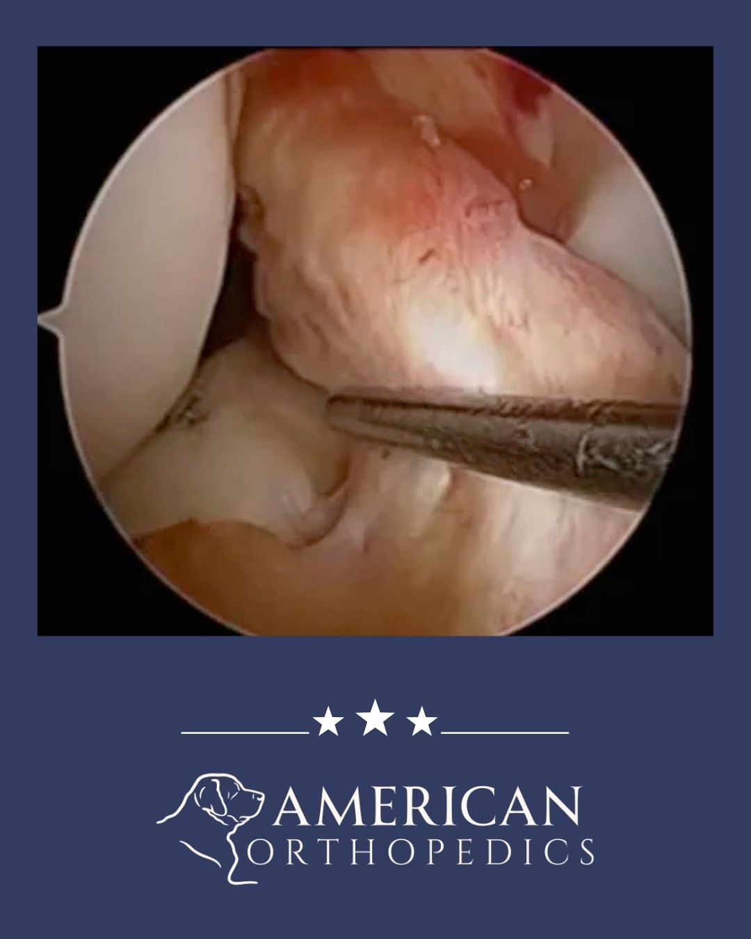 ACL reconstruction illustration dr drew ratner american orthopedics greenville sc (5)