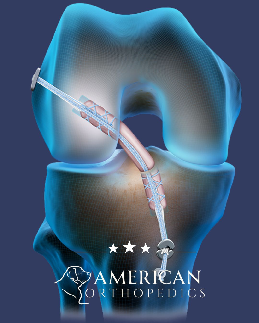 ACL reconstruction illustration dr drew ratner american orthopedics greenville sc