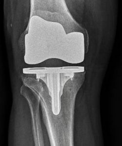 After Total Knee replacement Arthroplasty​ after - Drew Ratner MD Orthopedic Surgeon 1 (2)