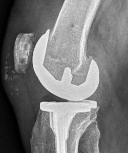 After Total Knee replacement Arthroplasty​ after - Drew Ratner MD Orthopedic Surgeon 1