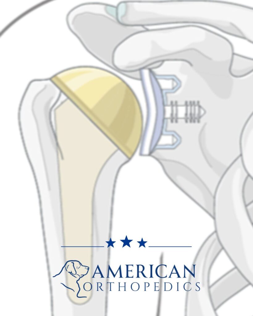 Anatomic Total Shoulder Replacement (TSA) dr drew ratner greenville