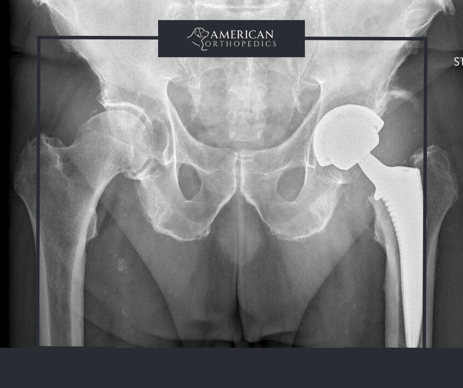 Anterior Total Hip Arthroplasty