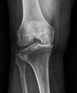 Before Total Knee replacement Arthroplasty​ after - Drew Ratner MD Orthopedic Surgeon 1 (2)