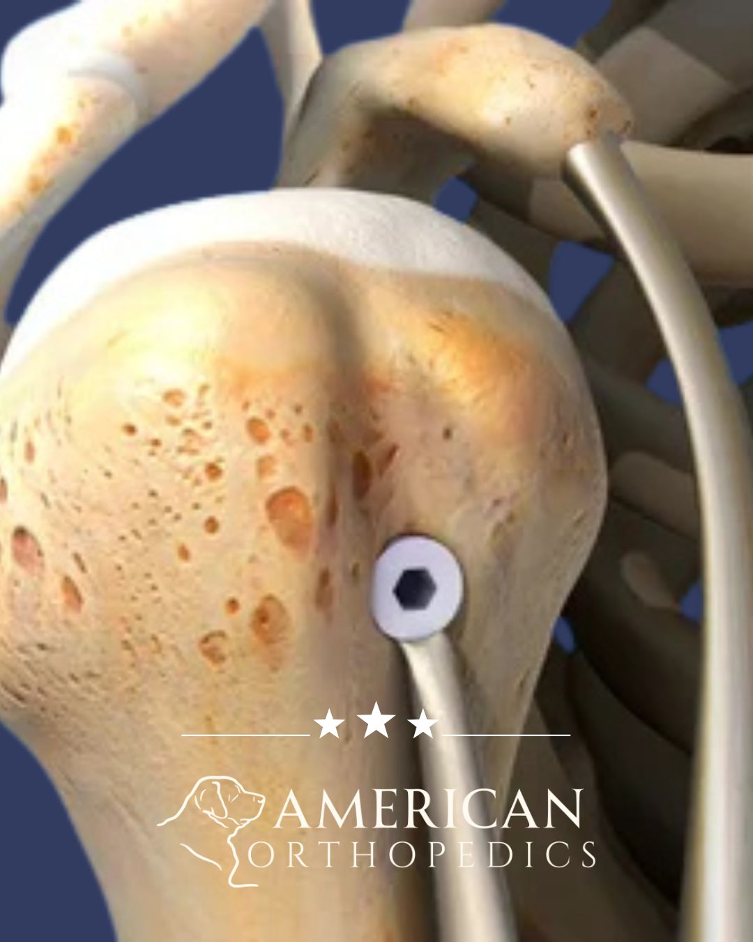 Biceps Tenodesis illustration dr drew ratner american orthopedics greenville sc
