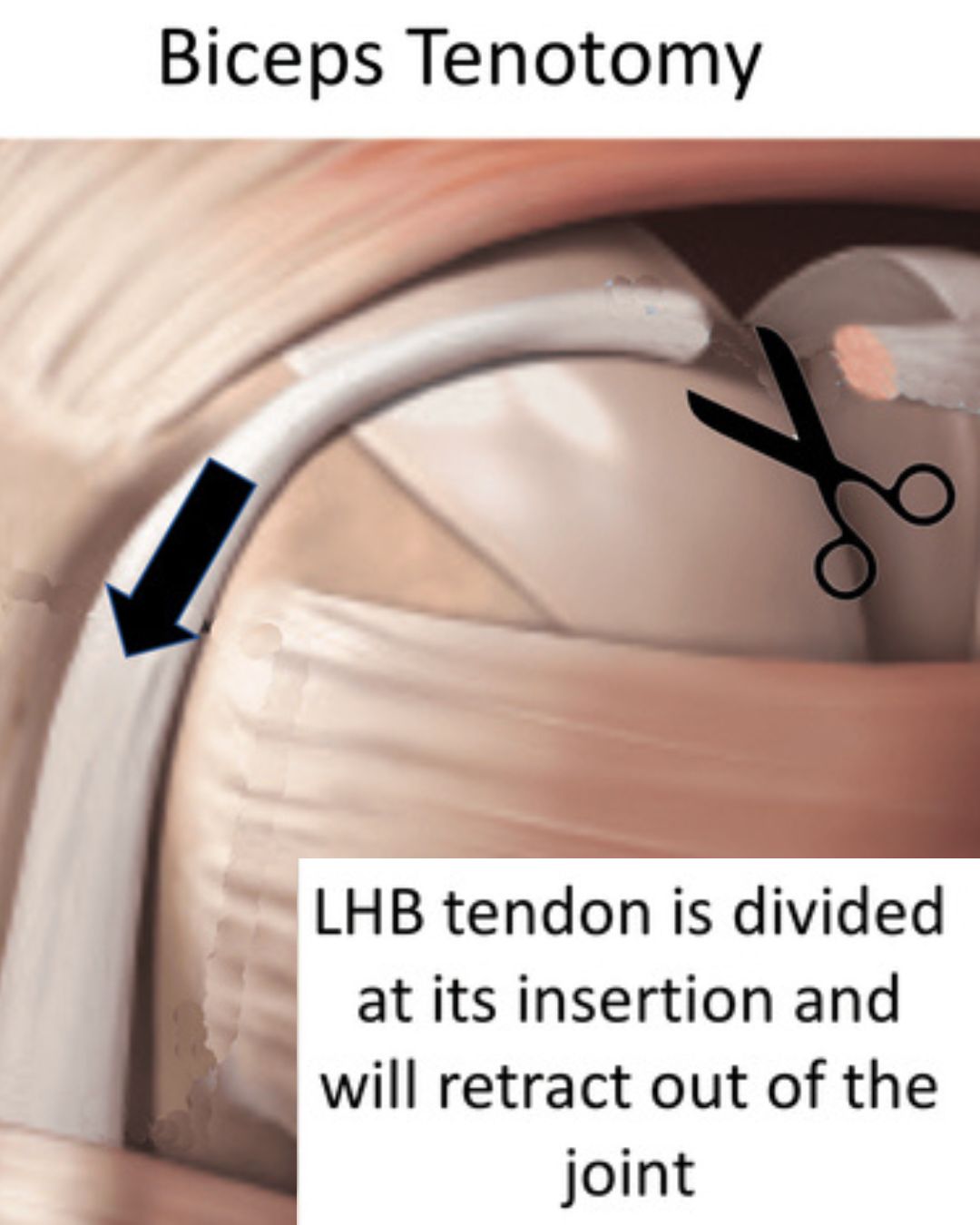 Biceps Tenotomy illustration dr drew ratner american orthopedics greenville sc