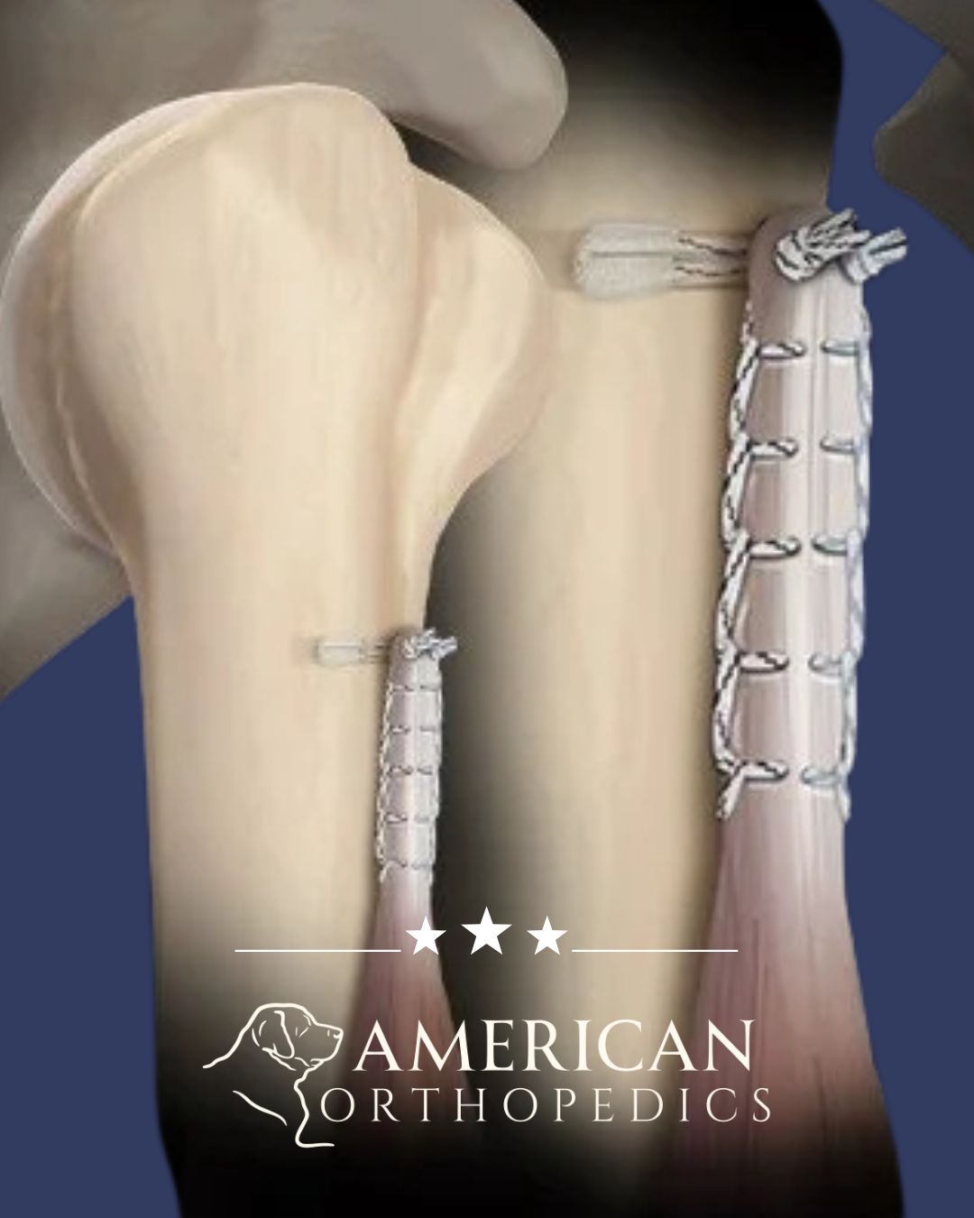 Biceps Tenotomy vs Tenodesis illustration dr drew ratner american orthopedics greenville sc