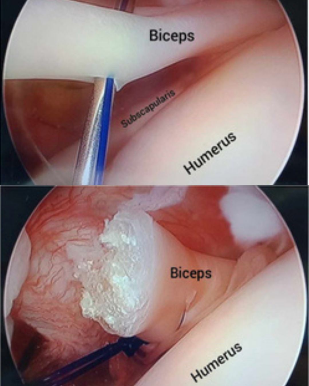 Biceps tendon photo dr drew ratner american orthopedics greenville sc