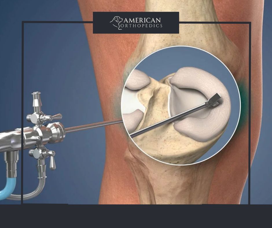 Partial Meniscectomy vs Meniscal Repair