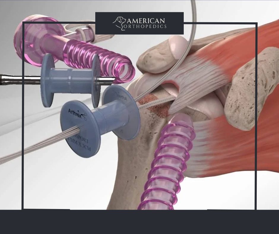 Rotator Cuff Repair