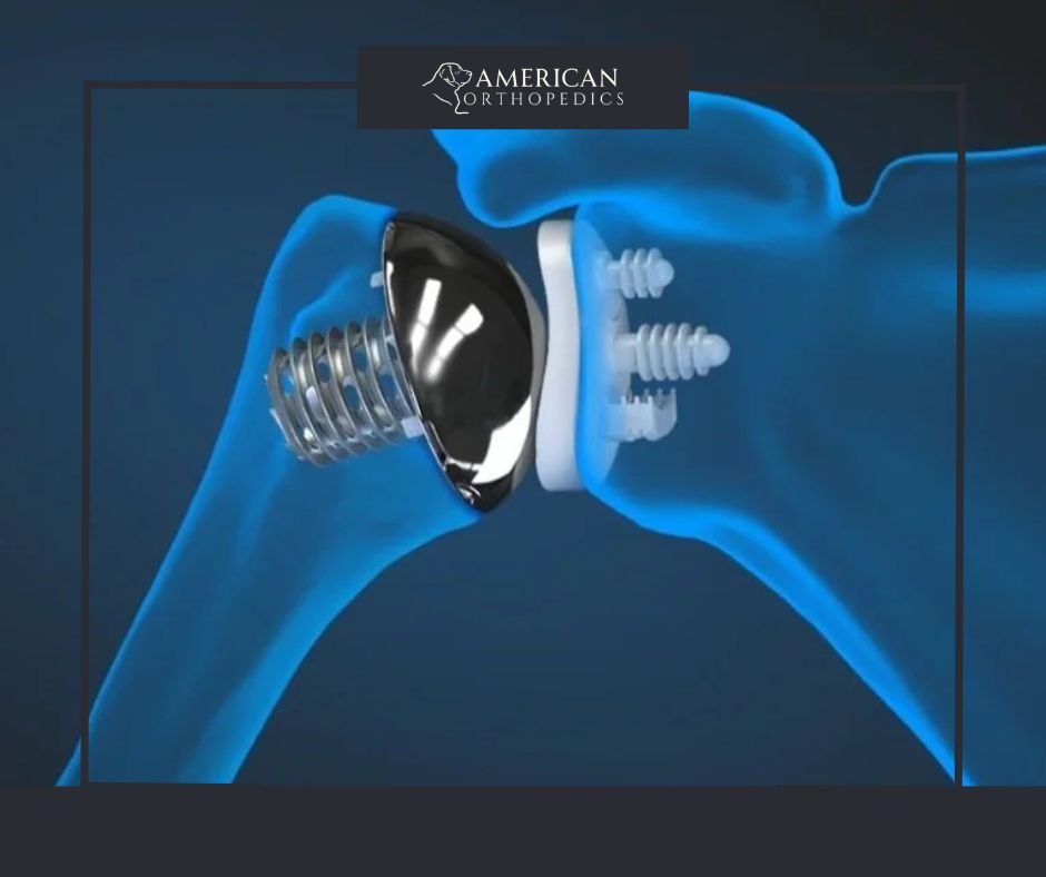 Shoulder Arthroplasty