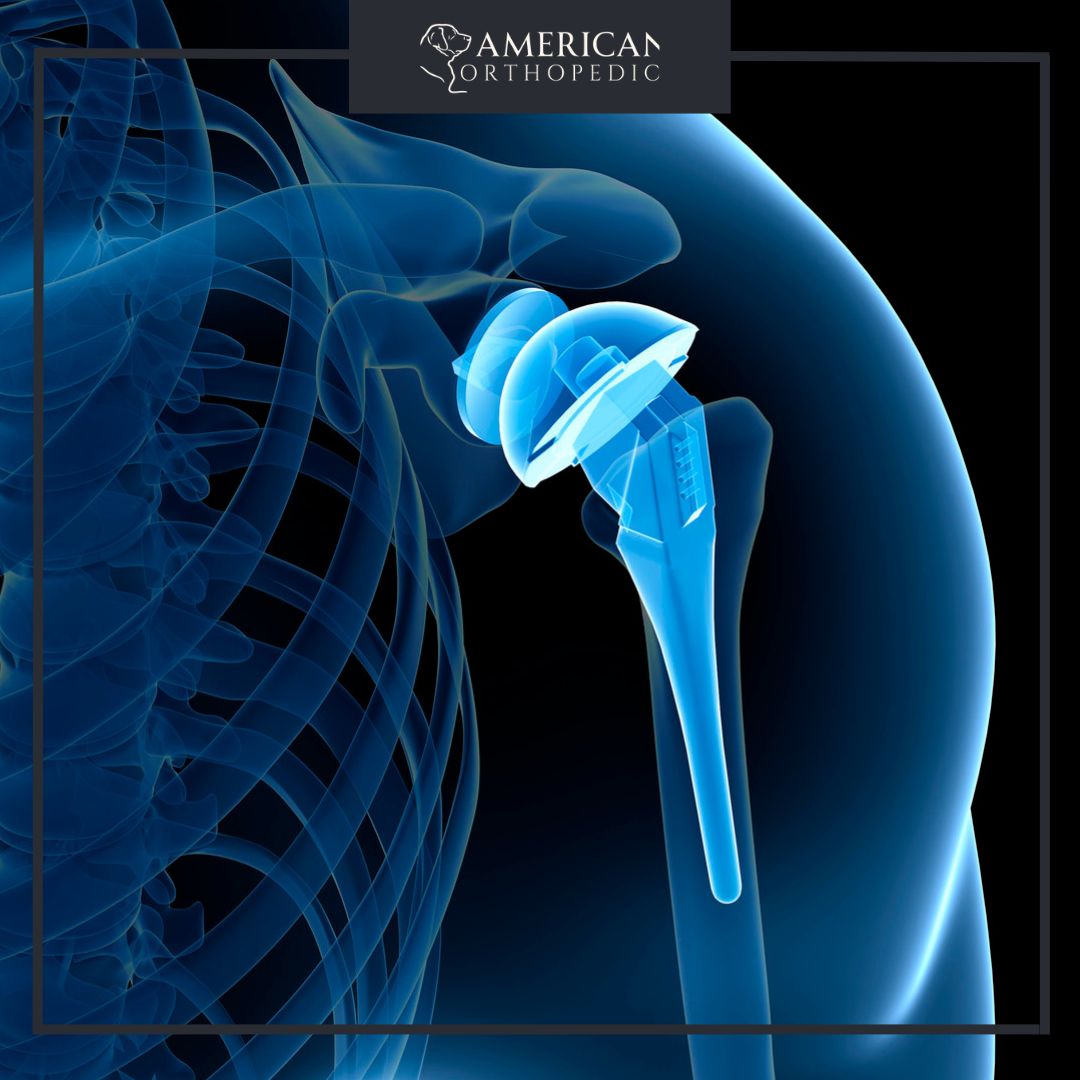 joint replacement American orthopedics