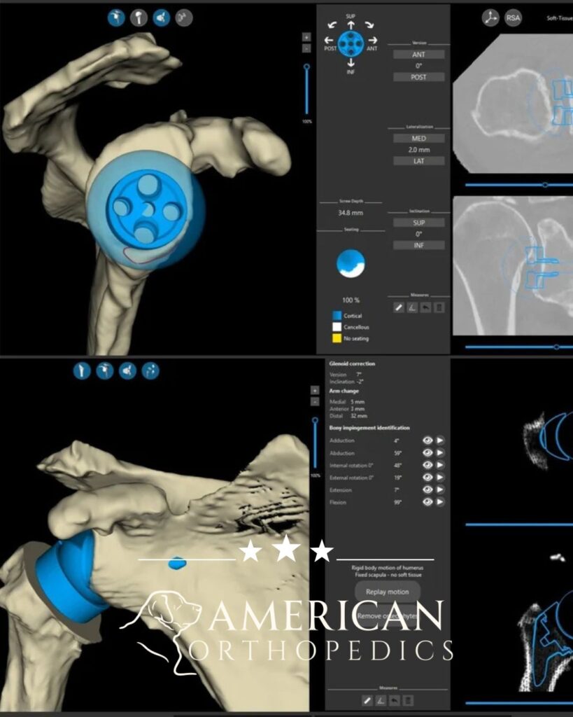 total shoulder replacement 3d computer dr drew ratner greenville