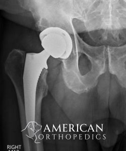 Anterior Hip Replacement for Osteoarthritis Arthropathy after - Drew Ratner MD Orthopedic Surgeon 1