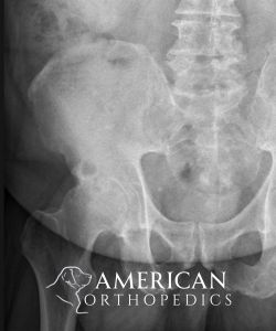 Anterior Hip Replacement for Osteoarthritis before - Drew Ratner MD Orthopedic Surgeon 1