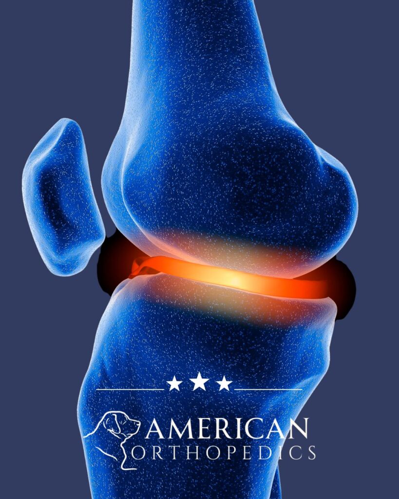 Meniscus illustration dr drew ratner american orthopedics greenville sc