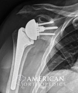 Reverse Total Shoulder for Rotator Cuff Arthropathy after - Drew Ratner MD Orthopedic Surgeon 1