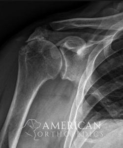 Reverse Total Shoulder for Rotator Cuff Arthropathy before - Drew Ratner MD Orthopedic Surgeon 1