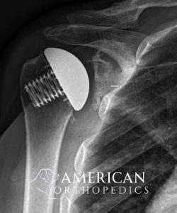 Total Shoulder Replacement after 54 - Drew Ratner MD Orthopedic Surgeon 1