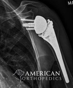 Total Shoulder Replacement after 70 - Drew Ratner MD Orthopedic Surgeon 1