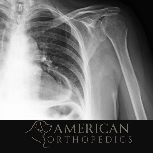 Pre Op X Ray Rotator Cuff Arthropathy